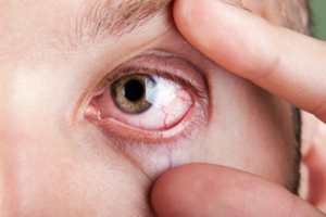 trombose ocular