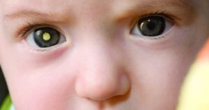 retinoblastoma-entenda