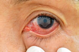 descolamento-de-retina