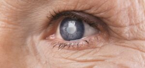 glaucoma