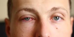 alergia ocular