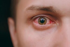 Automedicação ocular colirios