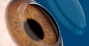 Transplante de córnea